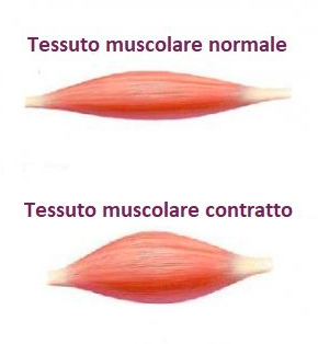 Contrattura muscolare Milano